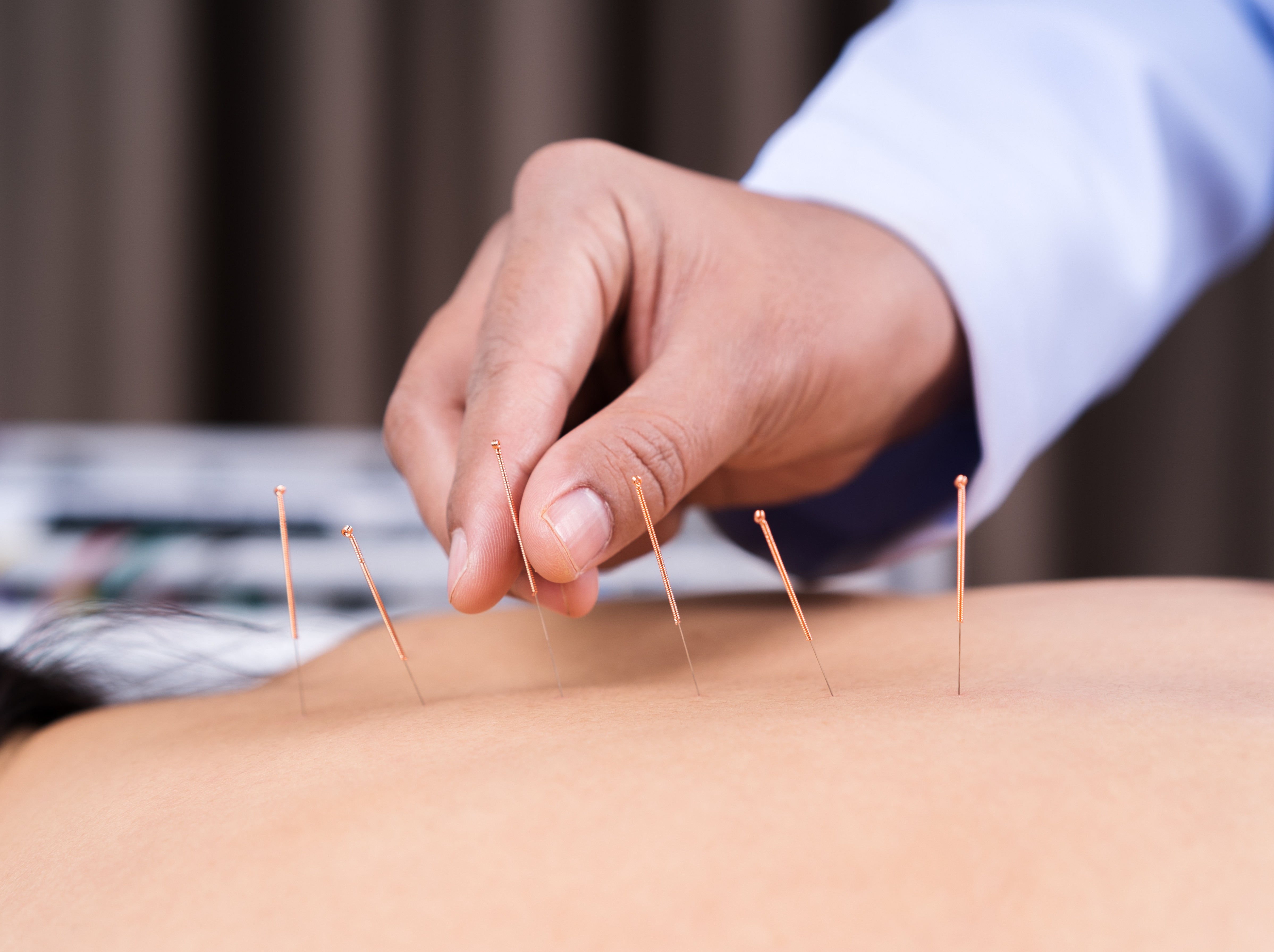 Acupuncture