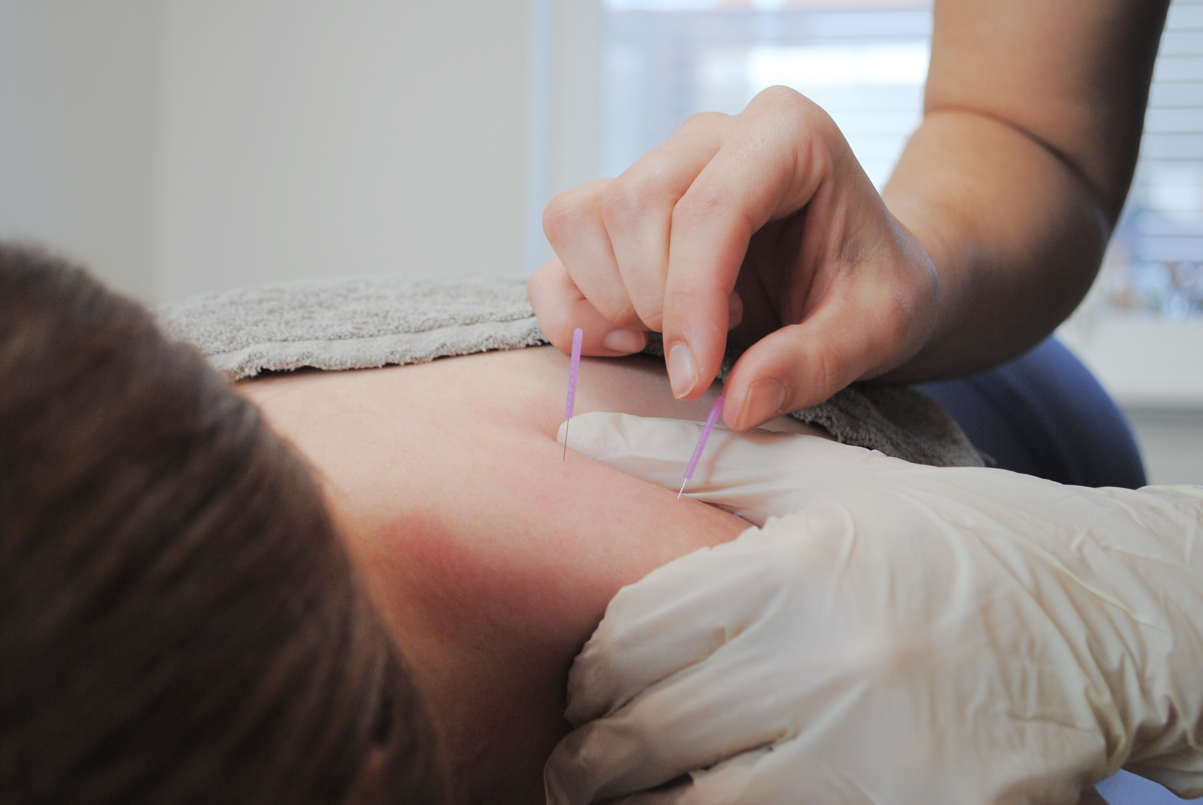 Why Chiropractors Use Dry Needling - And How It Helps