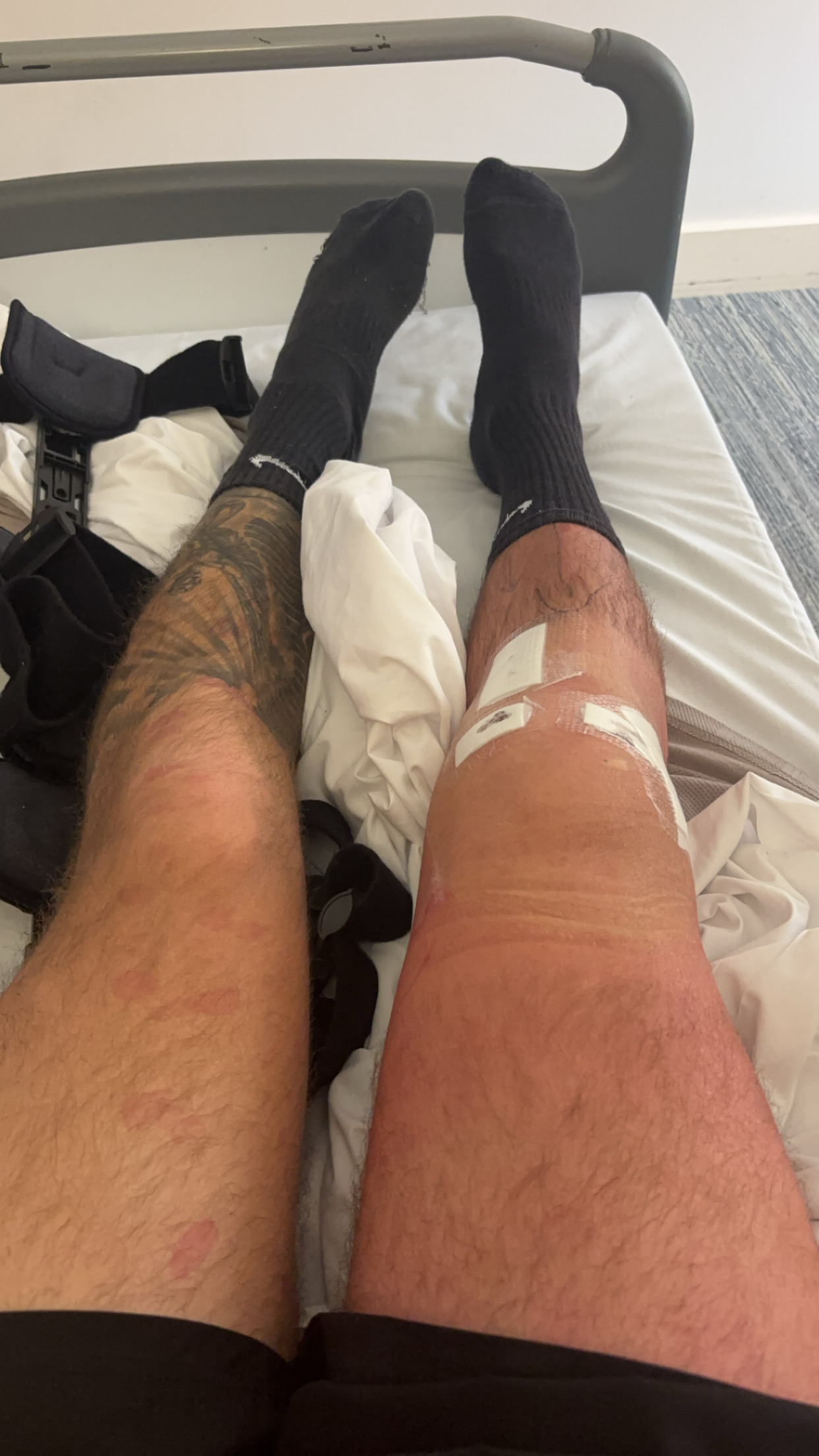 The Rehab Guide From a Physio: My Knee Surgery Recovery Journey